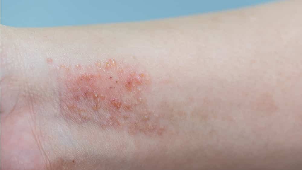 Dermatite atópica: saiba reconhecer a doença