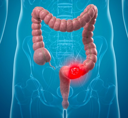Entenda por que o câncer de intestino está aumento em adultos entre 45 e 49 anos